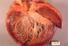 640px-Idiopathic_cardiomyopathy,_gross_pathology_20G0018_lores.jpg